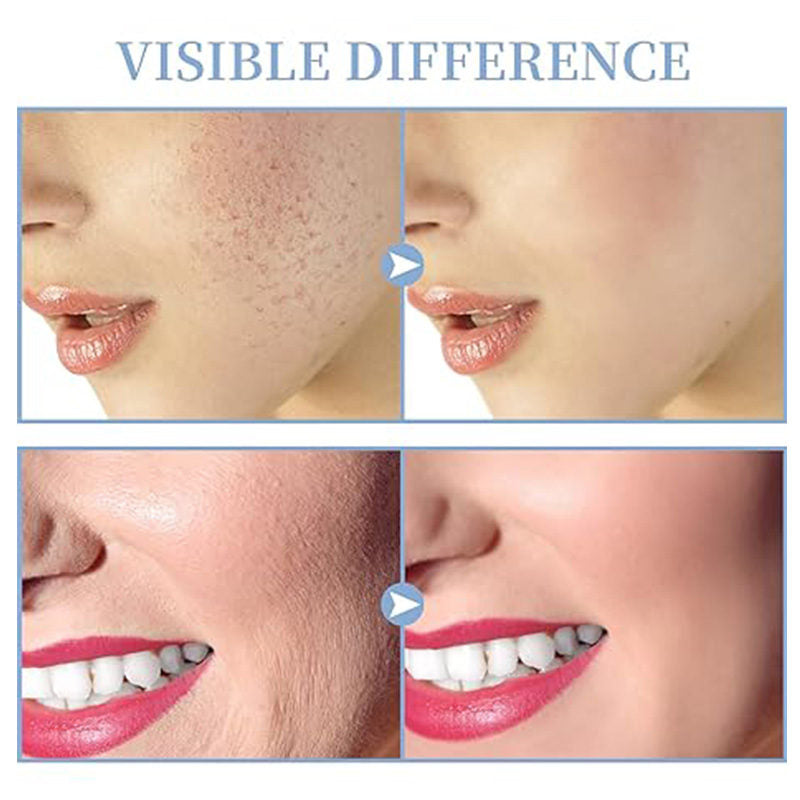 Beakey High Frequency Facial Machine Portable with 4 Different Tubes for Anti-Aging