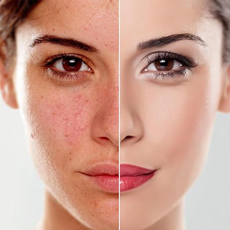 Beakey 3-in-1 Microdermabrasion Machine 0-68cmHg Strong Suction Power